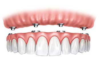 Dental Implant Bar